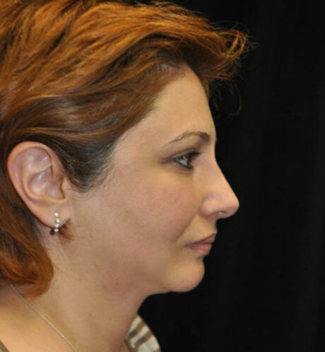 Facial Fat Grafting case #13837