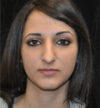 Rhinoplasty case #13849