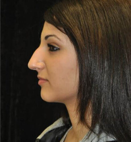 Rhinoplasty case #13849