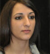Rhinoplasty case #13849