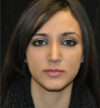 Rhinoplasty case #13849