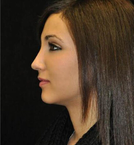Rhinoplasty case #13849