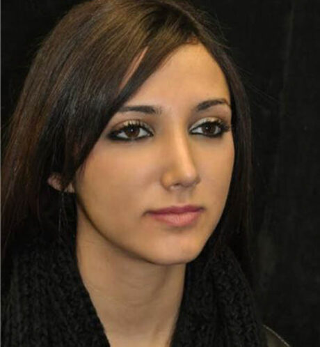 Rhinoplasty case #13849