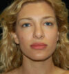 Revision Rhinoplasty case #13842