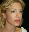 Revision Rhinoplasty case #13842