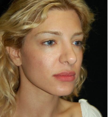 Revision Rhinoplasty case #13842