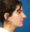 Revision Rhinoplasty case #13889