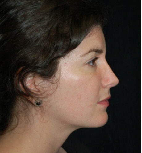 Revision Rhinoplasty case #13889