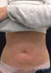 JuvaShape case #13870