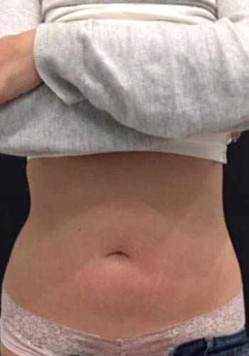 JuvaShape case #13870