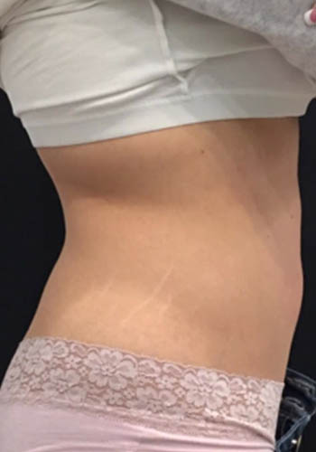 JuvaShape case #13870
