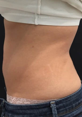JuvaShape case #13870