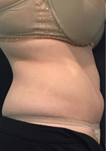 JuvaShape case #13870