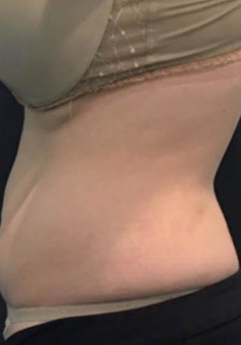 JuvaShape case #13870