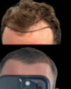 FUE Hair and Eyebrow Transplant case #15155