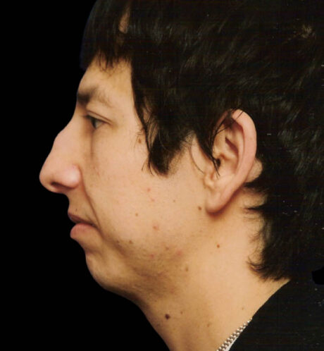 Rhinoplasty case #15338