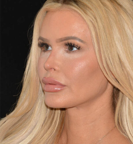 Revision Rhinoplasty case #15054
