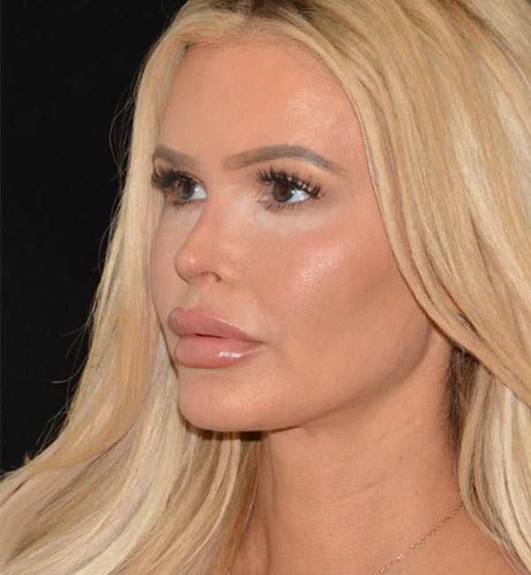 Revision Rhinoplasty case #15054