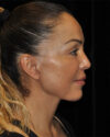 Facelift case #15033