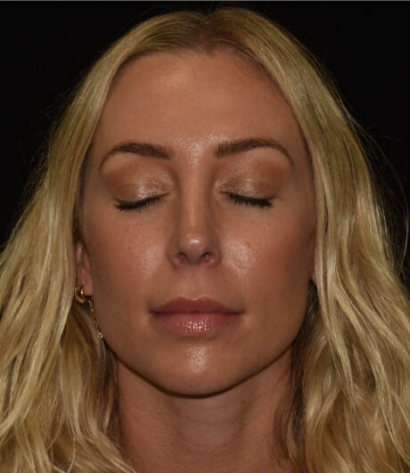 Revision Rhinoplasty case #15161