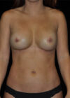 Breast Implant Removal With Fat Transfer Replacement case #15047