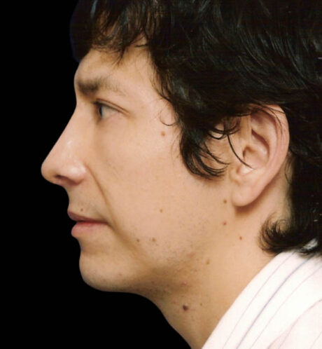 Rhinoplasty case #15338