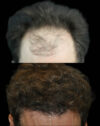 FUE Hair and Eyebrow Transplant case #15153