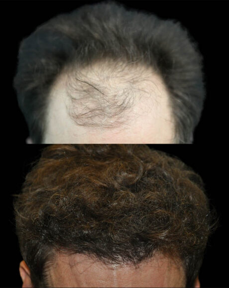FUE Hair and Eyebrow Transplant case #15153