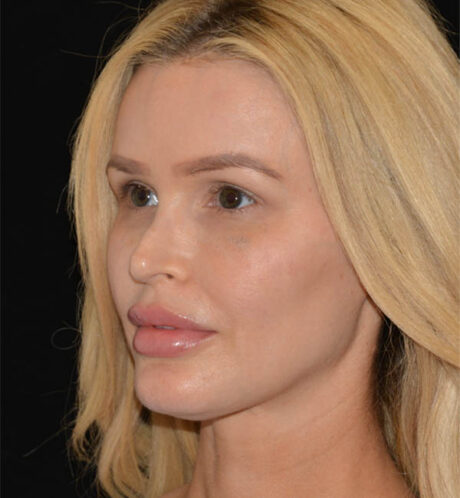 Revision Rhinoplasty case #15054