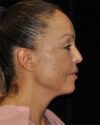 Facelift case #15033