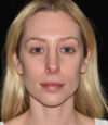 Revision Rhinoplasty case #15161