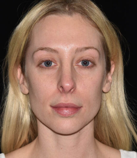 Revision Rhinoplasty case #15161