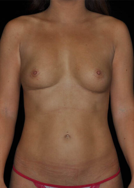 Breast Implant Removal With Fat Transfer Replacement case #15047