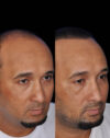 FUE Hair and Eyebrow Transplant case #15151