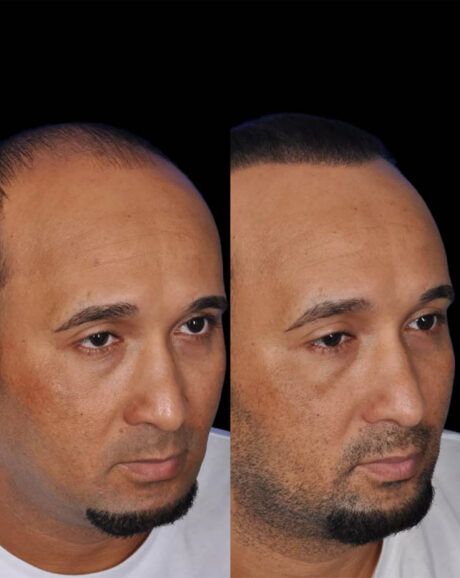 FUE Hair and Eyebrow Transplant case #15151