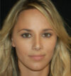 Rhinoplasty case #15297