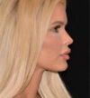 Revision Rhinoplasty case #15054