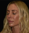Revision Rhinoplasty case #15161