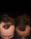 FUE Hair and Eyebrow Transplant case #15149