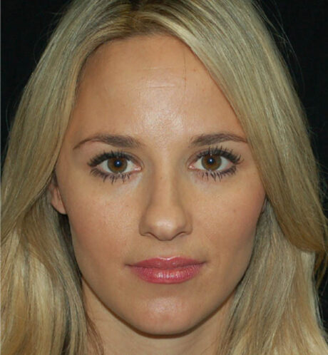 Rhinoplasty case #15297