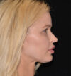 Revision Rhinoplasty case #15054