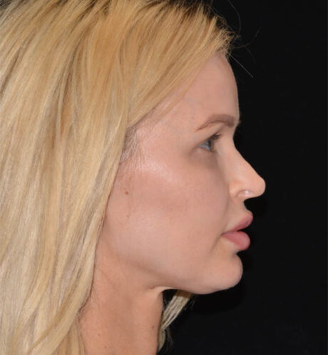 Revision Rhinoplasty case #15054
