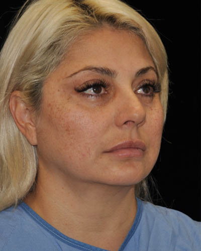 Facelift case #15036