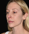 Revision Rhinoplasty case #15161