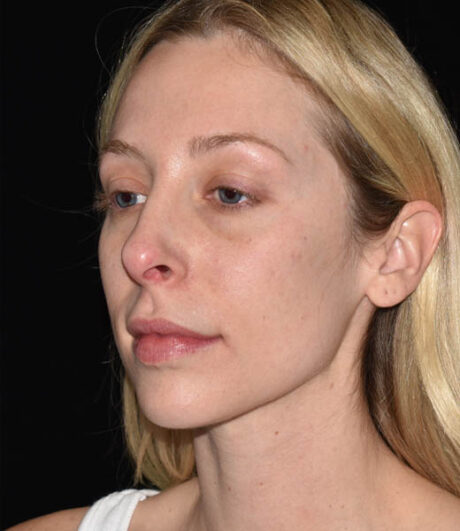Revision Rhinoplasty case #15161