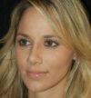 Rhinoplasty case #15297