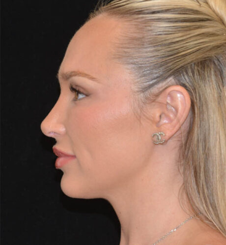 Revision Rhinoplasty case #15059