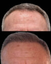 FUE Hair and Eyebrow Transplant case #15146