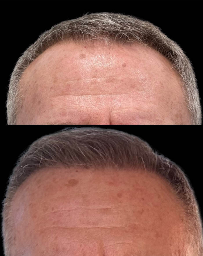 FUE Hair and Eyebrow Transplant case #15146