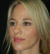 Rhinoplasty case #15297